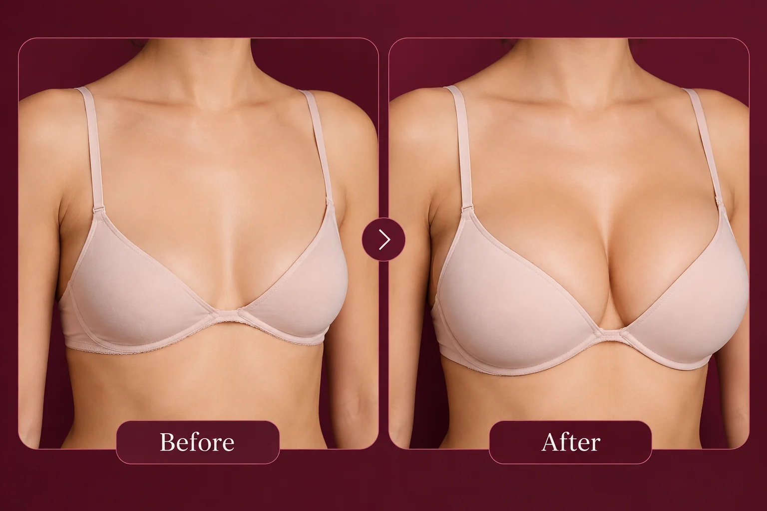 AI-generated illustration showing the same torso in a bra before and after breast enhancement, labelled Before and After; not a real patient.